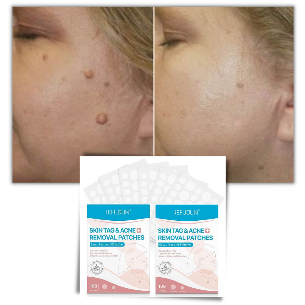 Natural Skin Patch - Effectively Remove Moles and Warts!